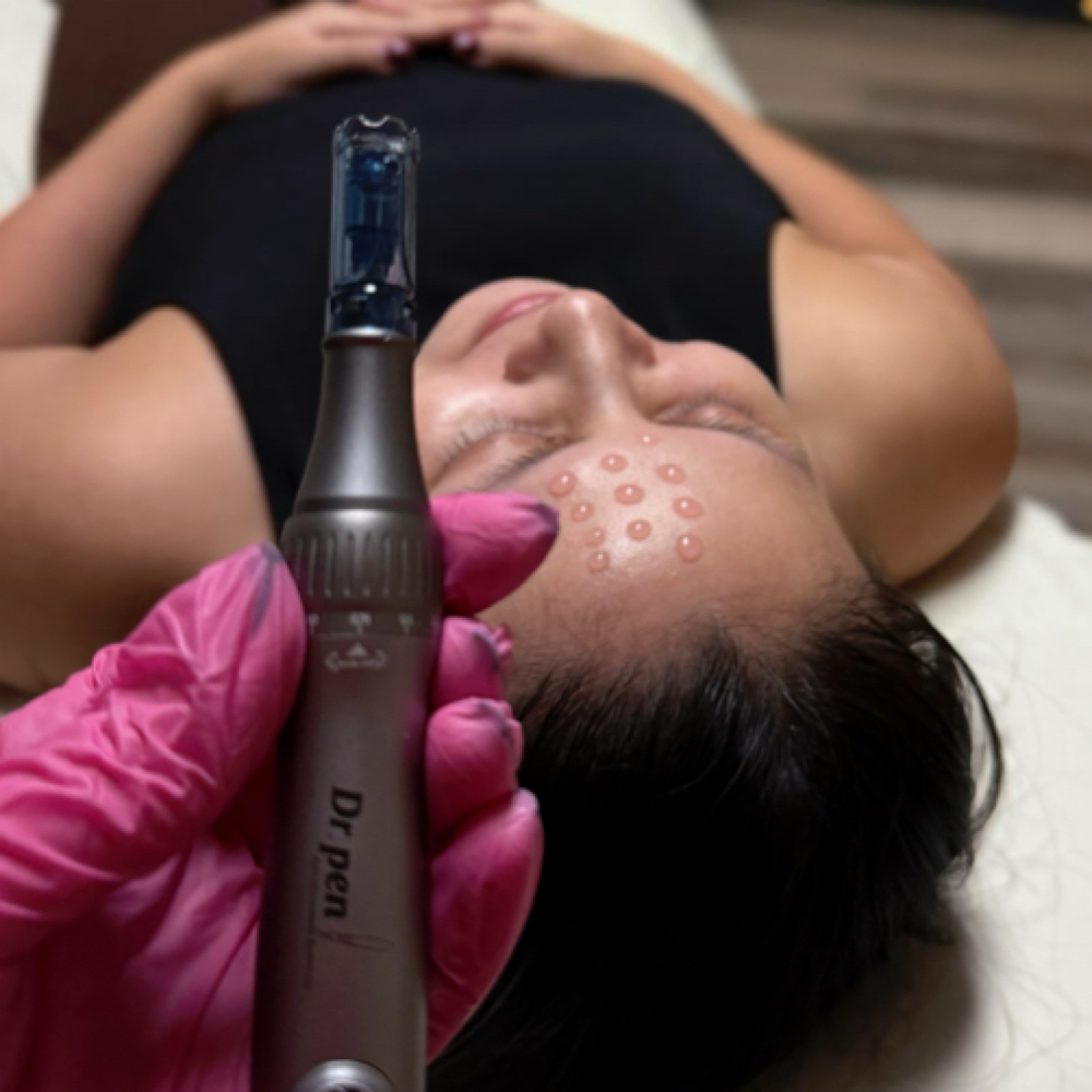 Microneedling Face at Bonita Esthetics in St Louis Park, MN