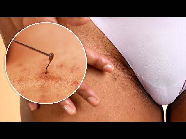 Bikini Area Extractions with High Frequency Treatment