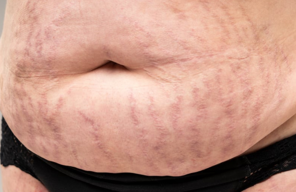 Full Stomach Stretchmark Camouflage