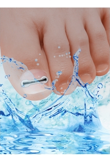 Ingrown/ Involuted Nail REPAIR