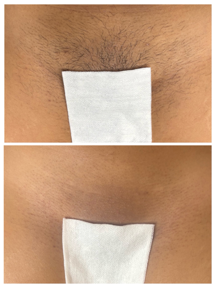 Brazilian Wax