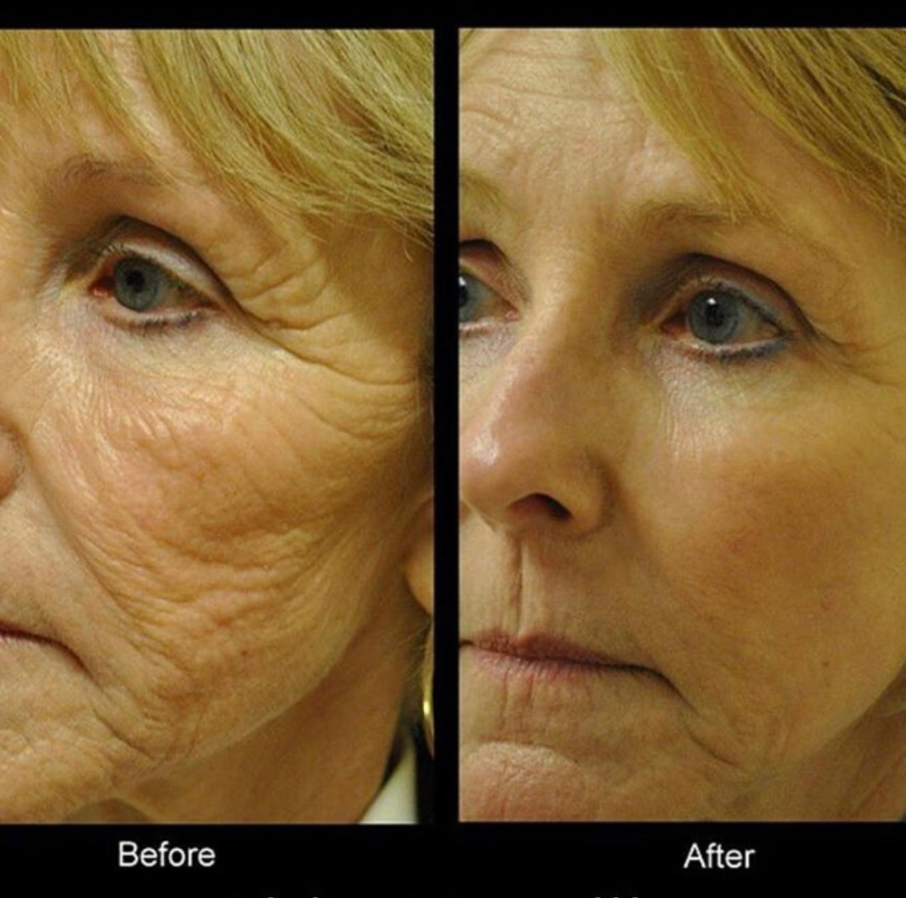 Microneedling/Collagen Induction