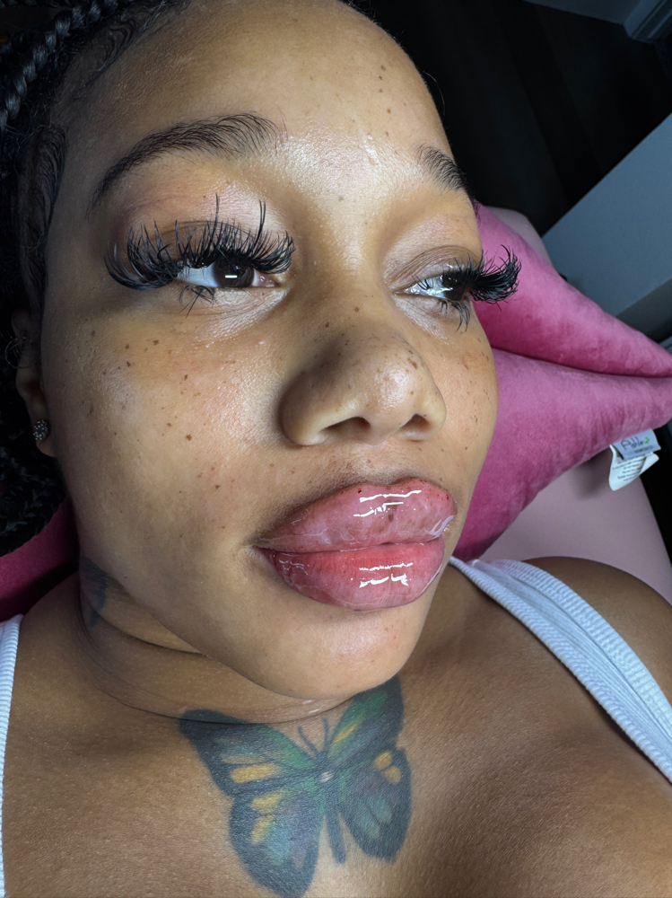 Traditional 1.1ML Needle