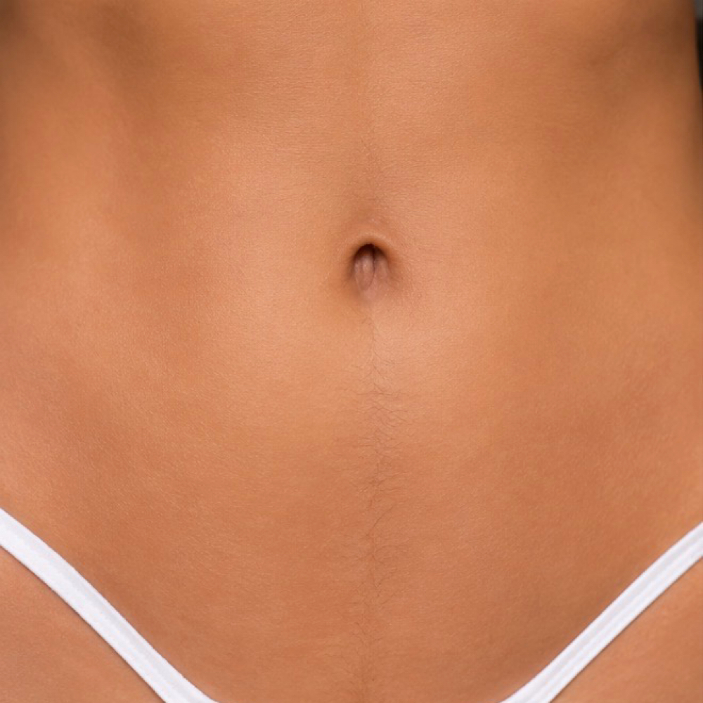Belly Strip at Natural Glow Esthetics in Escondido, CA