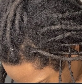 Matte Separation (AKA Loc Surgery)