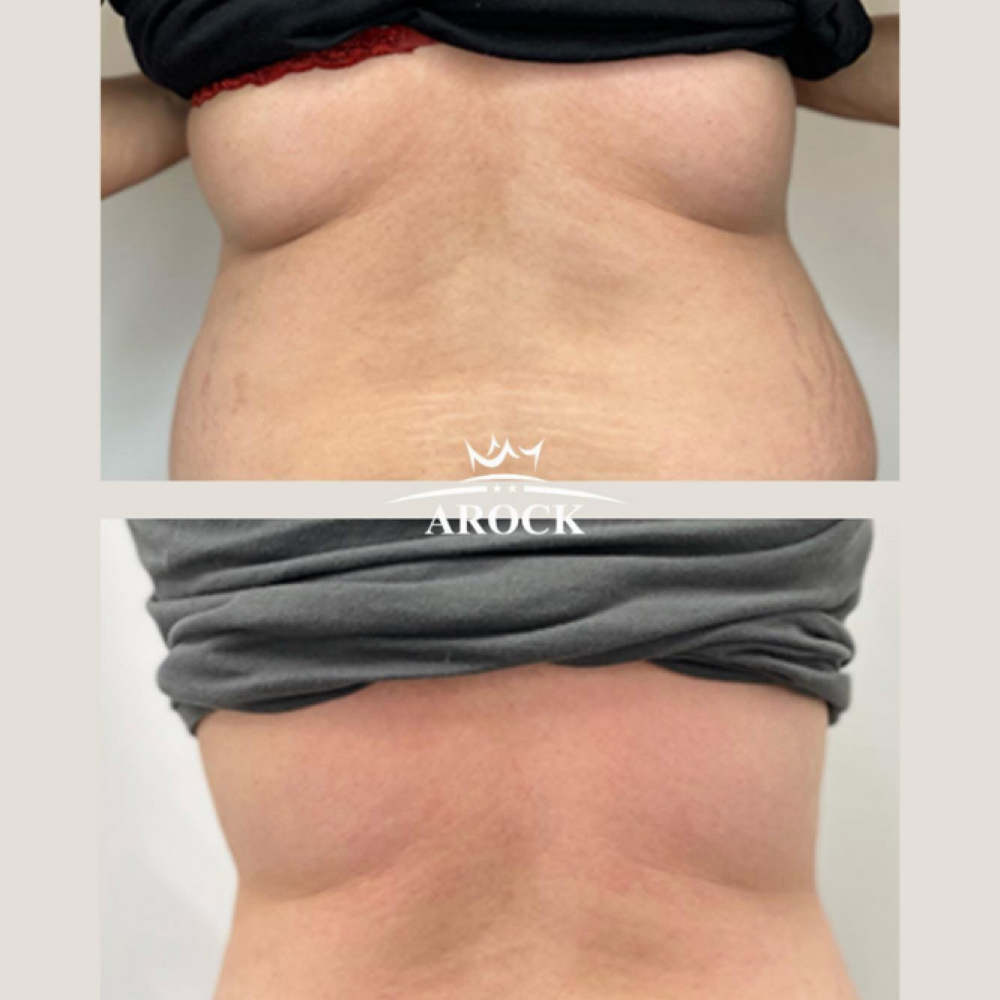 Lypolitics at ARock Beauty & Wellness in San Angelo, TX
