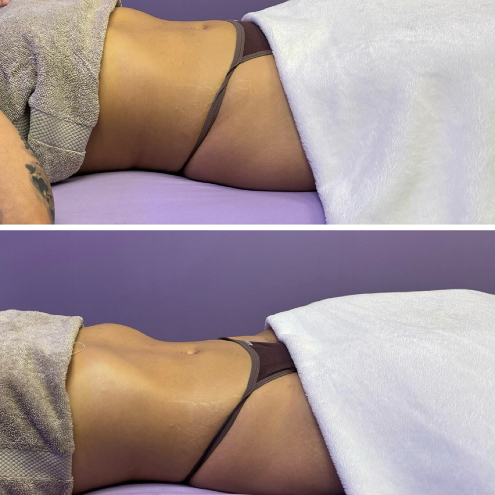 New Client-Brazilian Lymphatic at Divinity Essence Spa in Winter Springs, FL