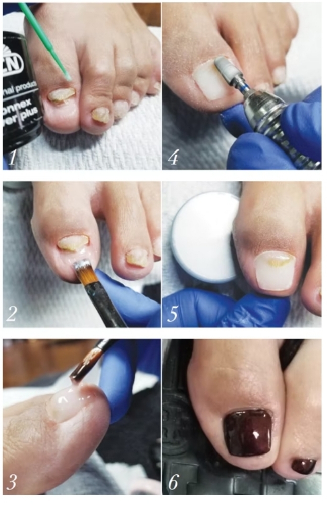 Reconstructed Toe Nail Add On