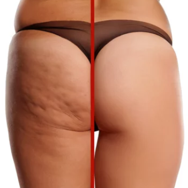 Cellulite Reduction Session at Skin Retribution in Roseville, CA