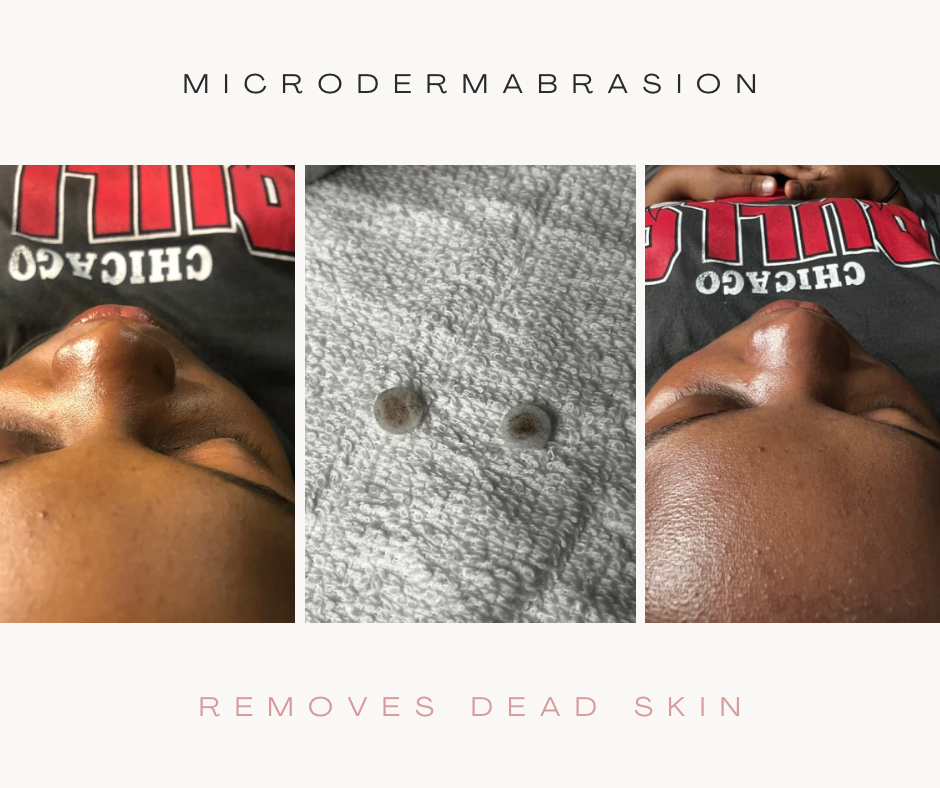 Diamond Micodermabrasion