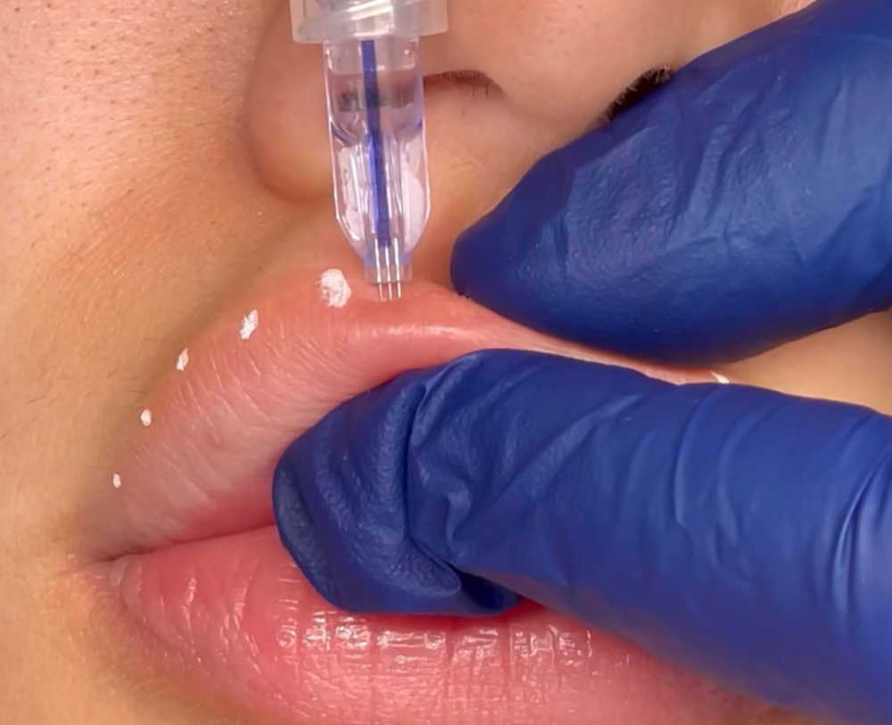 Micro Needle Lip Border