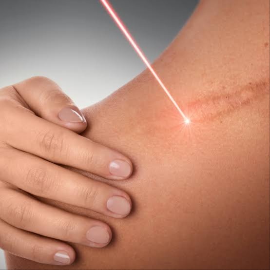 Resurface Luxe Laser Therapy at Zen Beauty in McAllen, TX