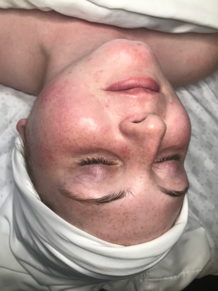 Corrective Facial at WYN SKIN & BROWS in Dallas, TX