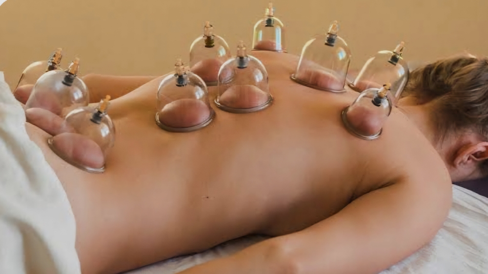 Cupping Therapy