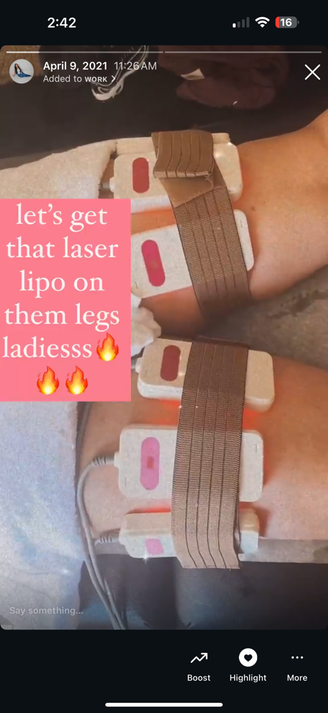 Cellulite Thigh Reduction