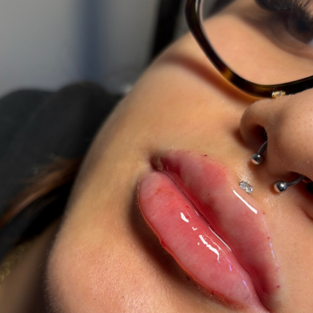 2-3 week touch Up  1 Fully Syringe at AIKO AESTHETICS in Melrose Park, IL