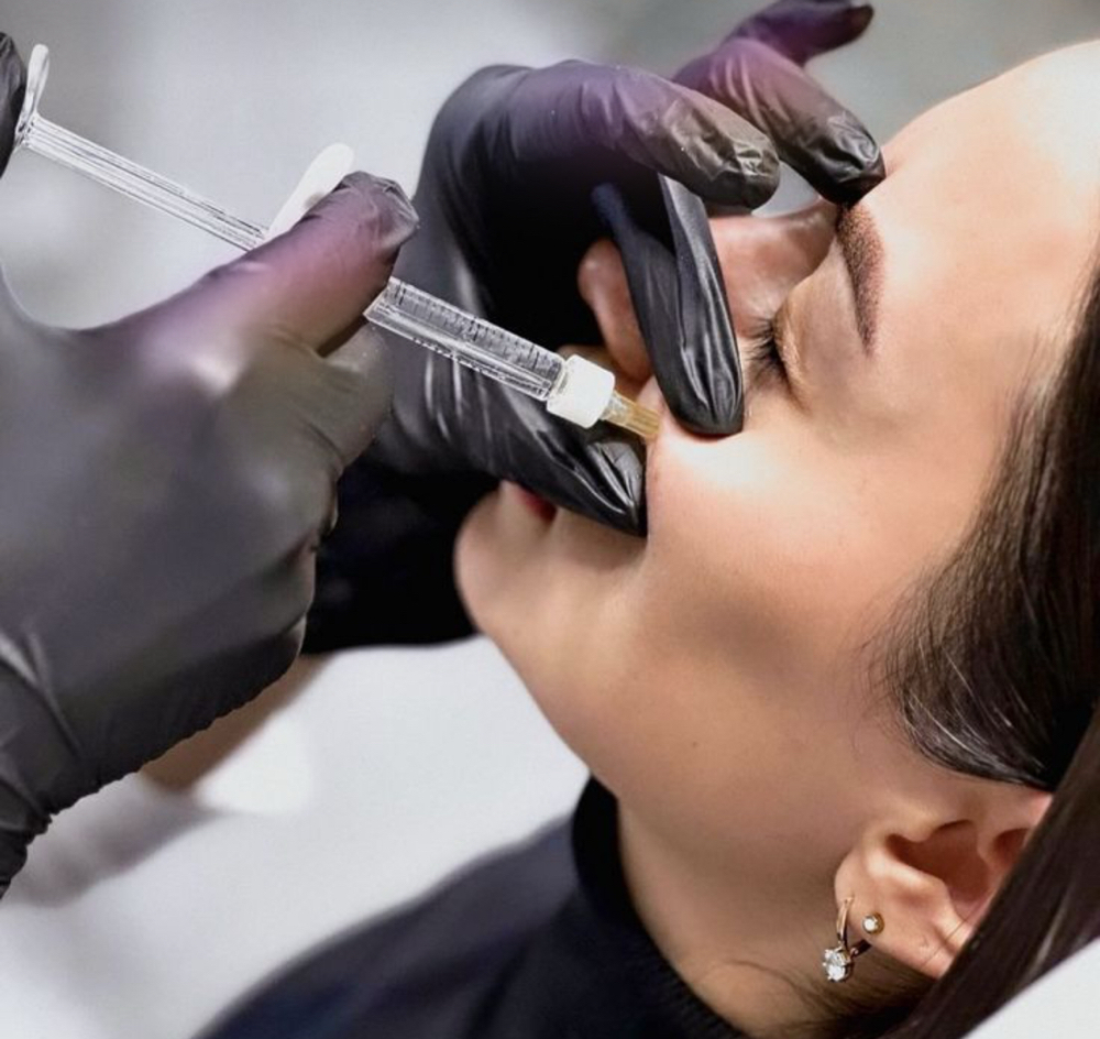 Cheek Filler at Perfection Injections in Euless, TX