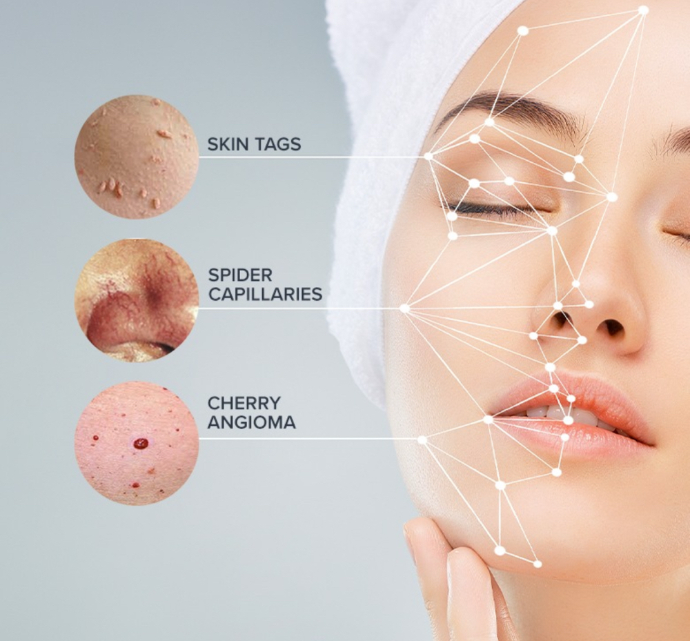 ThermoClear Treatment (30 Minuntes)