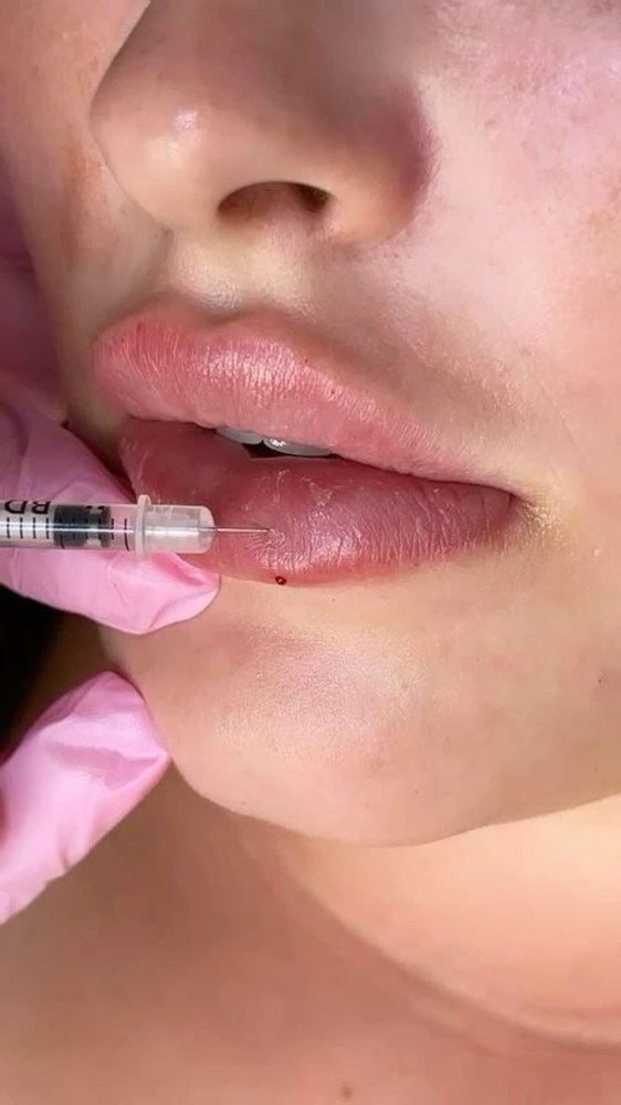 Model Fee Lip Filler