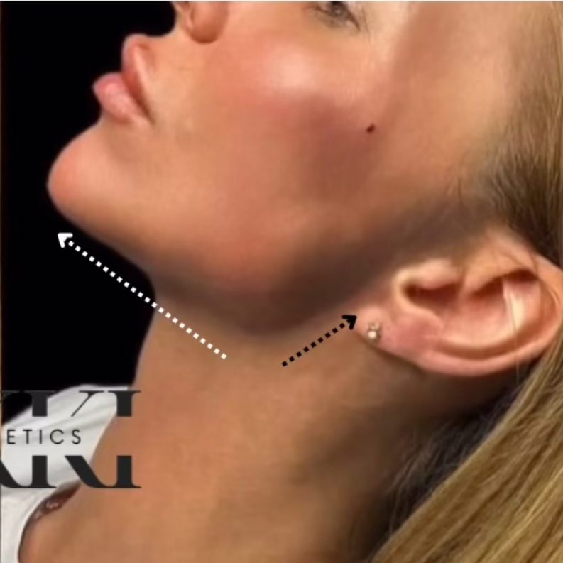 Jawline Filler (ML) at Akki Aesthetics in Williston Park, NY
