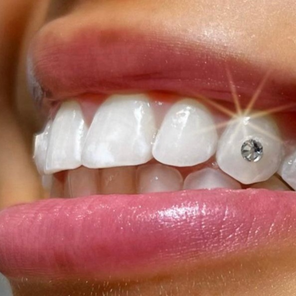 Combo Soft Whitening + 1 Gems at Royal Blanc Smiles - Teeth Whitening and Tooth Gems in Charlotte, NC in Charlotte, NC