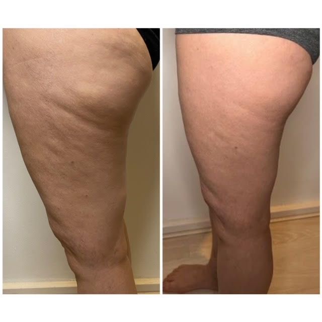 Spagirl Body Treatment Legs at Dew Drop Aesthetics LLC in Fort Smith, AR