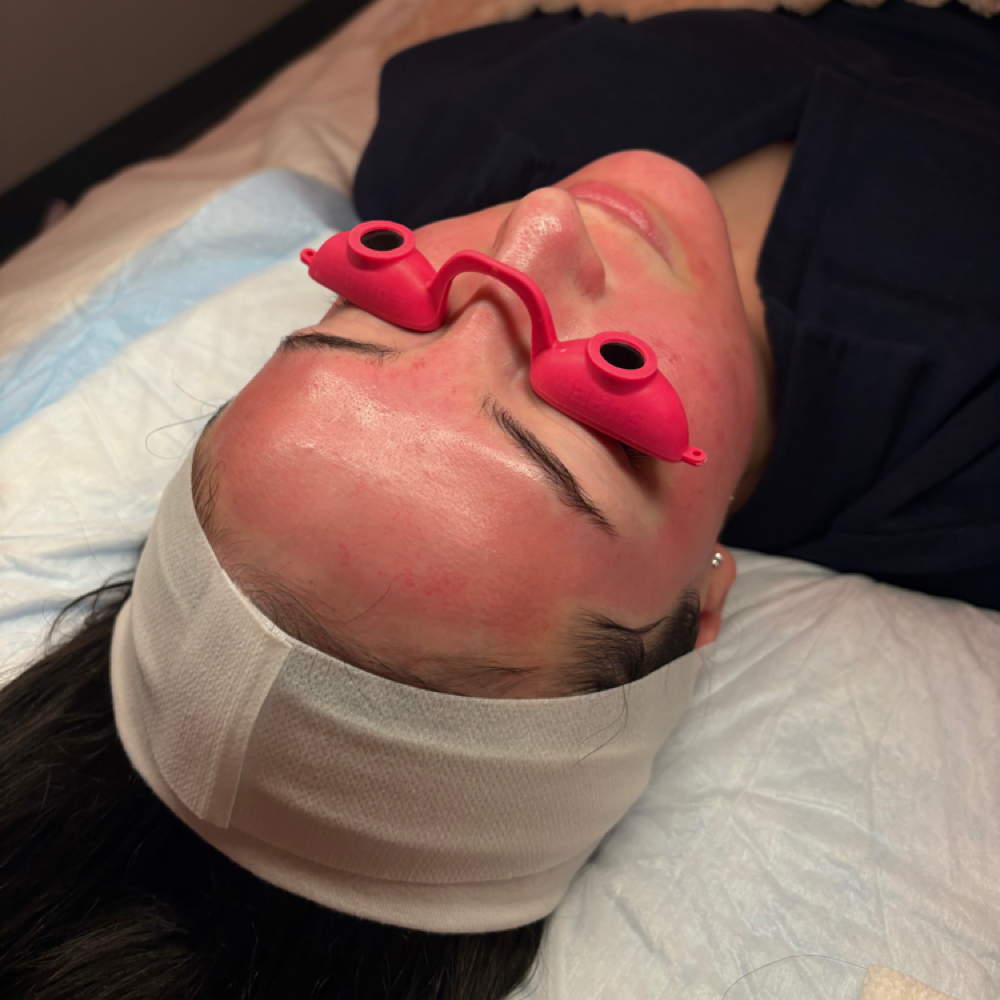 Add On Neck - Microneedling at Euphoria Skin in Chandler, AZ