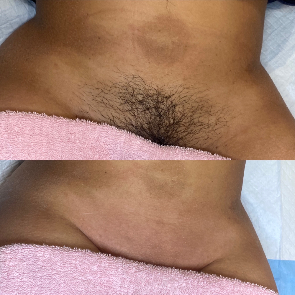Brazilian Wax Package 1