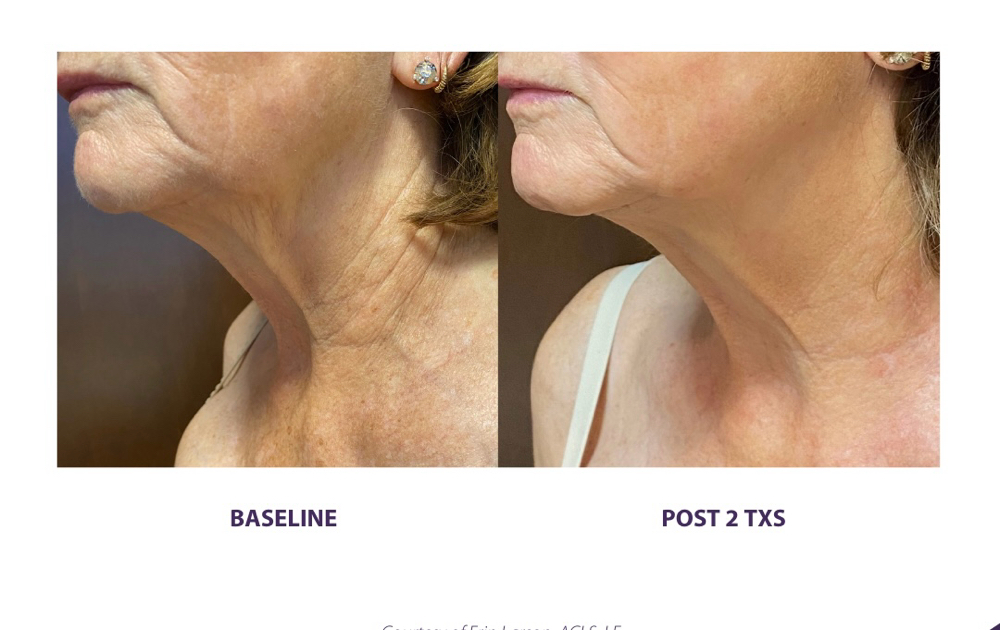 Three-Session Neck Rejuvenation Pro