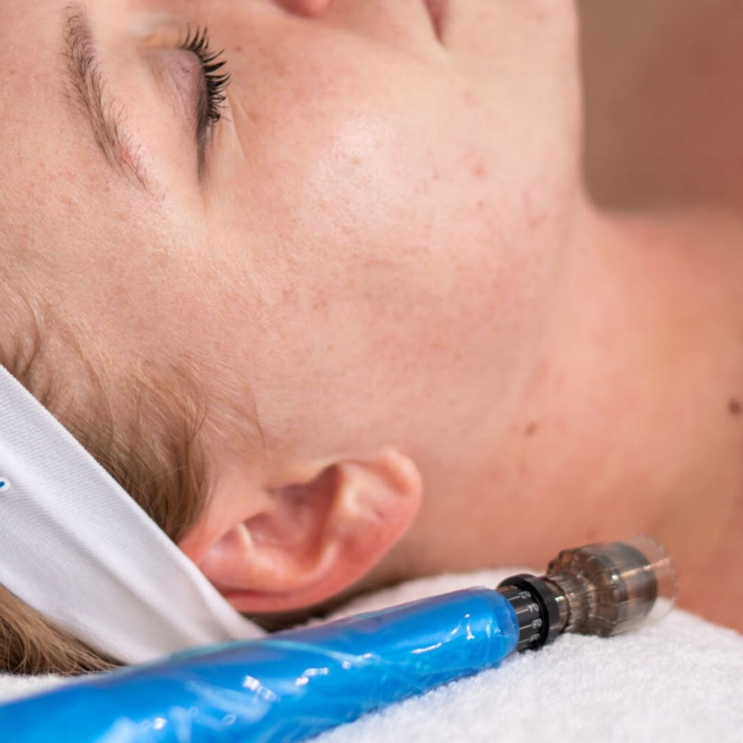Microneedling at Skinglowwithliza in Charlotte, NC