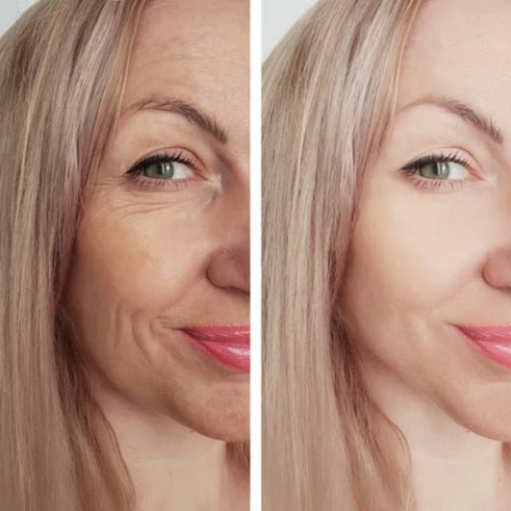 Advanced Resurfacing Peel