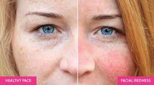 Facial for the Rosacea Beauties