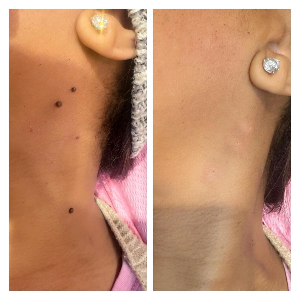 Mole Removal By Plasma Frequency