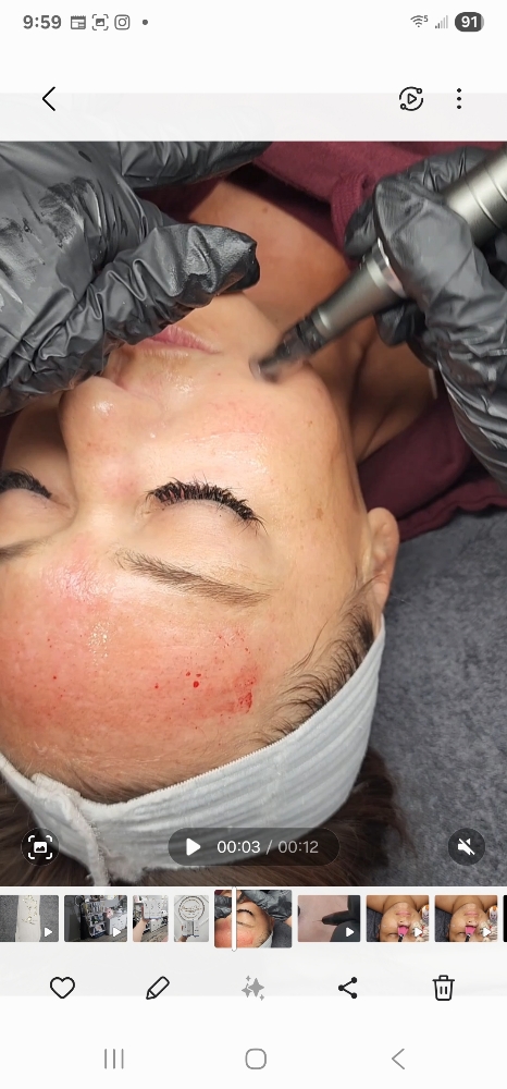 Microneedling Treatment
