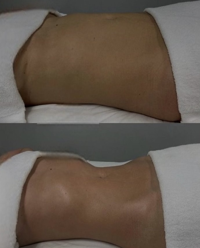 Stomach Lymphatic Drainage
