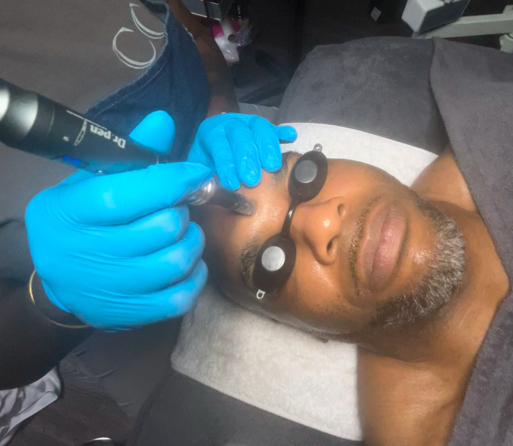 Microneedling Facial