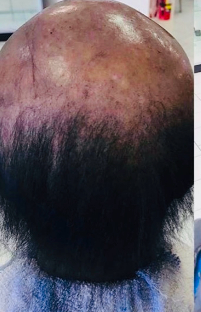 Alopecia Quick Weave
