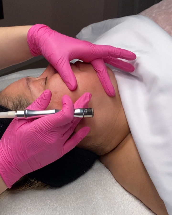 Micro Dermabrasion