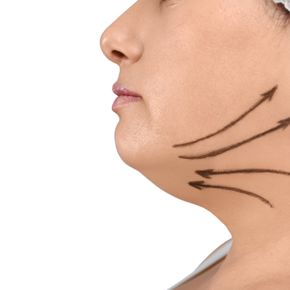 Chin Lipo Post-Op Lymphatic D at Brazilian Body Sculpting in San Diego, CA