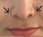 Piriform Fossa Filler