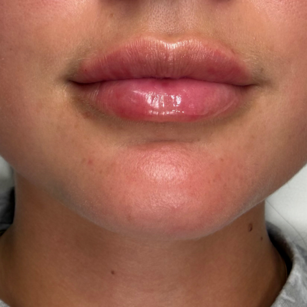 Mini Lip at Sedona Aesthetics and Wellness - Lauren Sawyer, RN, BSN in Kalama, WA