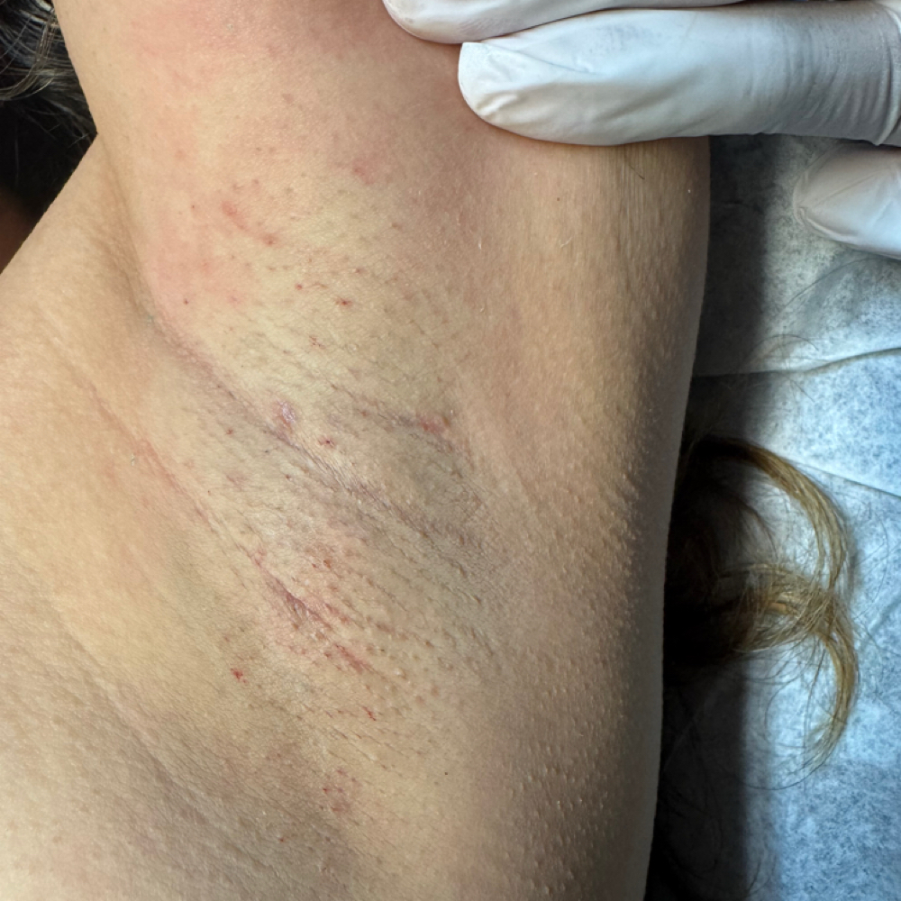 Underarms at Cataleia Skin Aesthetics (Redlands) in Redlands, CA