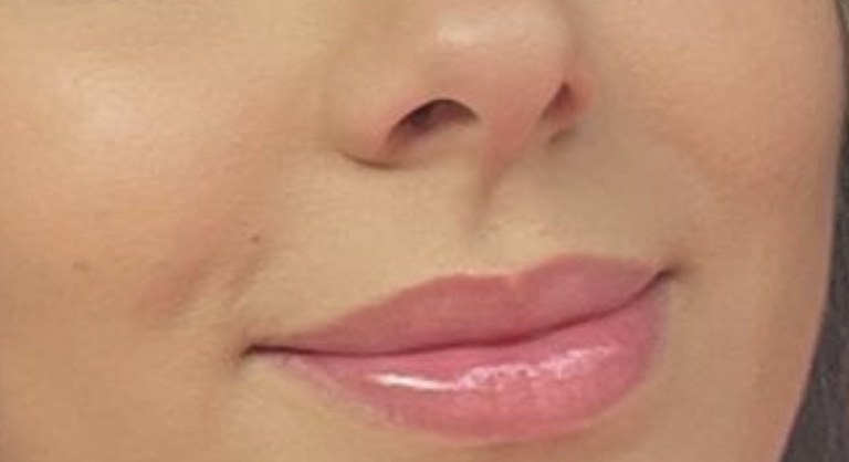 Upper Lip