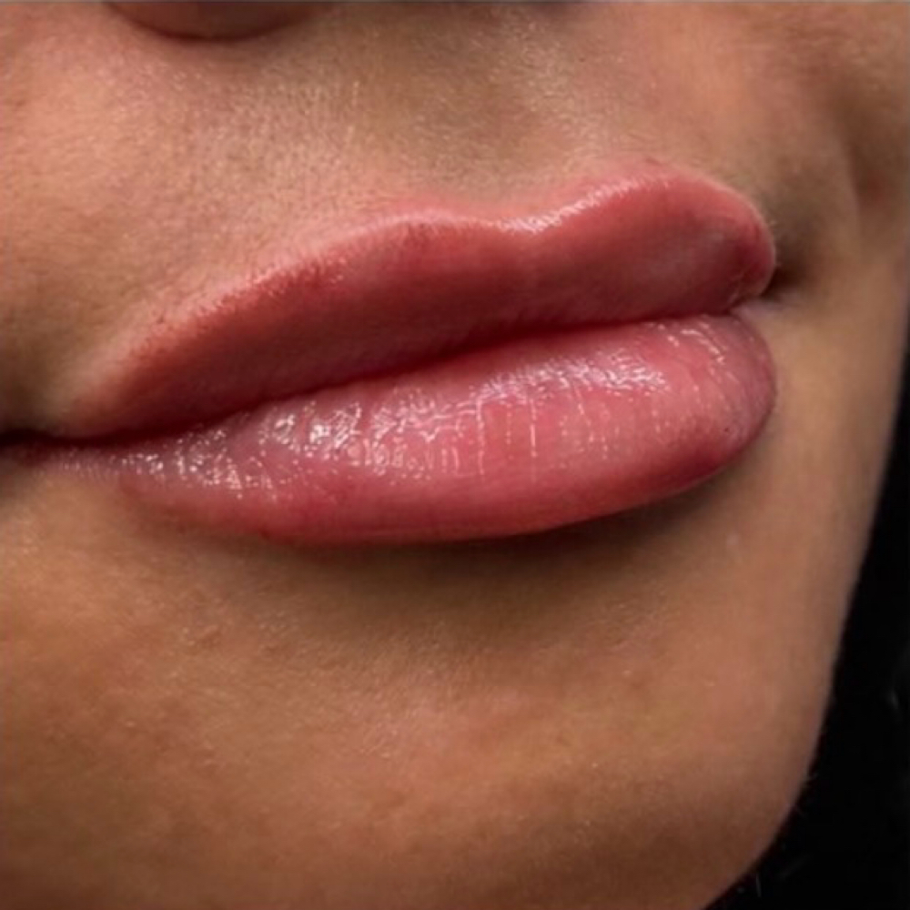 Lip Filler at KB Aesthetics PLLC in Brighton, MI