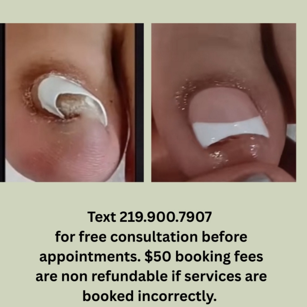 Ingrown  Removal/ Restoration at Chicago's Favorite Nail Spa in Lansing, IL