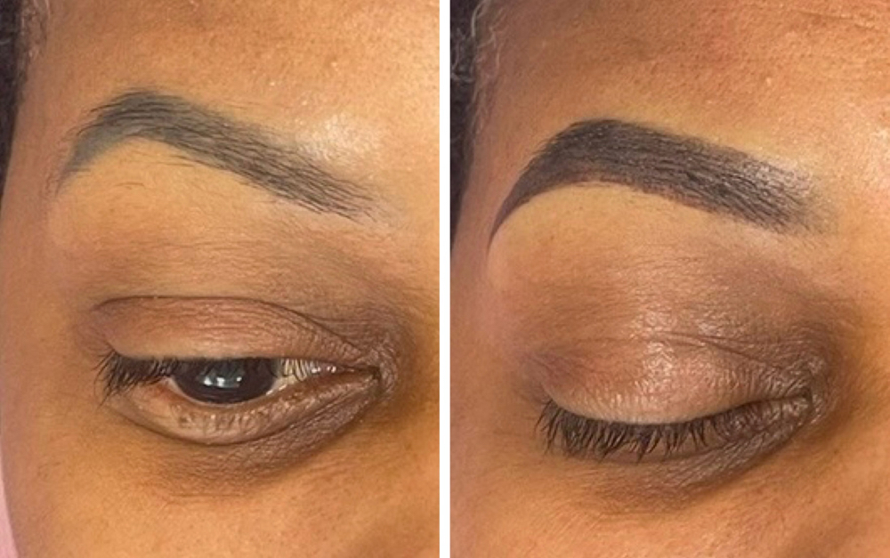 Correction Brow