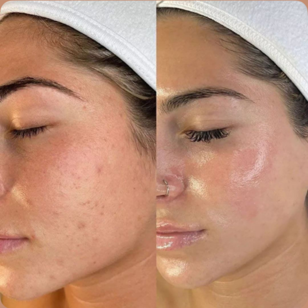 Golden Hour Acne Facial at Golden Hour Esthetics & More in Warsaw, IN