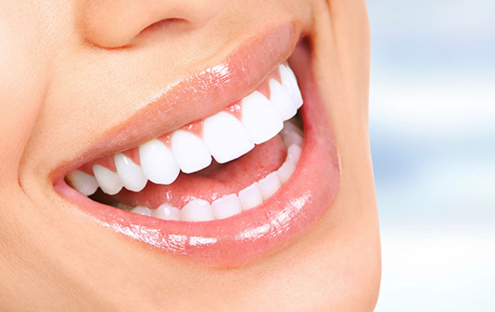 Teeth Whitening
