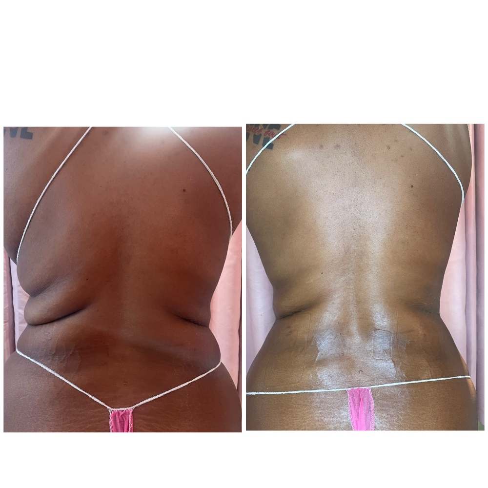 Liquid Lipo Upper Back Lower Bk