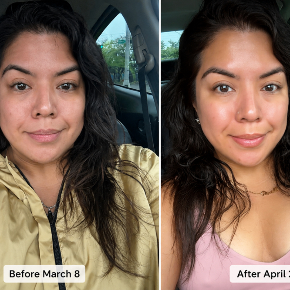 Glutathione (Glow Shot) at TRES Aesthetics in Missouri, TX